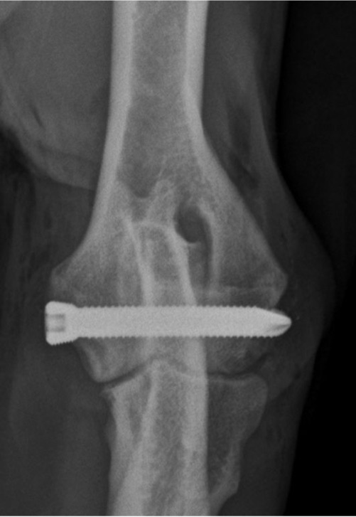 X-ray of a dog's elbow after humeral intracondylar fissure (HIF/IOHC) surgery