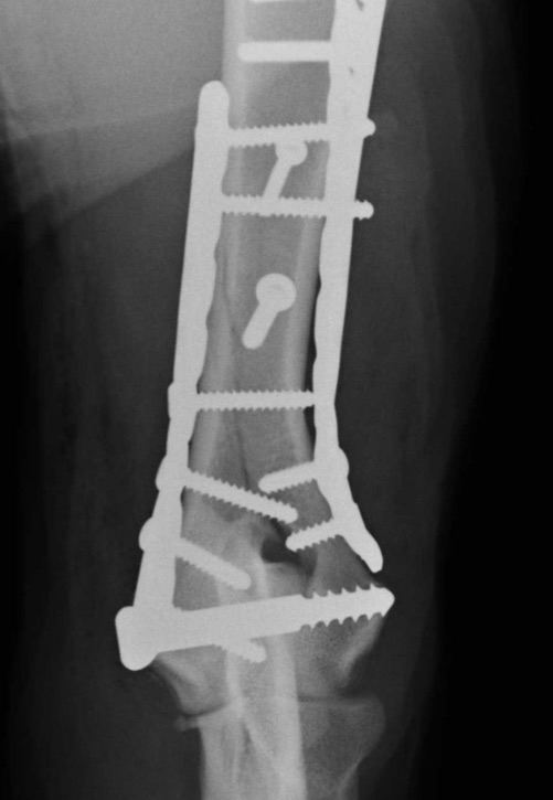 X-ray after repair of a humeral 'Y' fracture